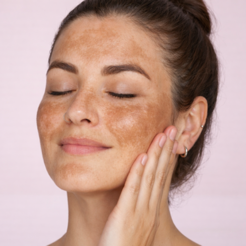 beautiful woman with melasma and hyperpigmentation