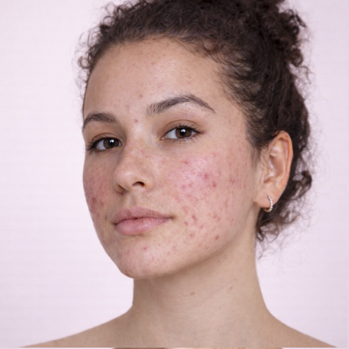Acne